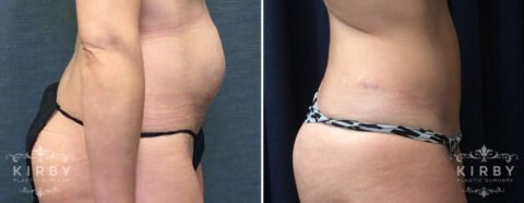 Right side profile view of female patient before and after tummy tuck Fort Worth