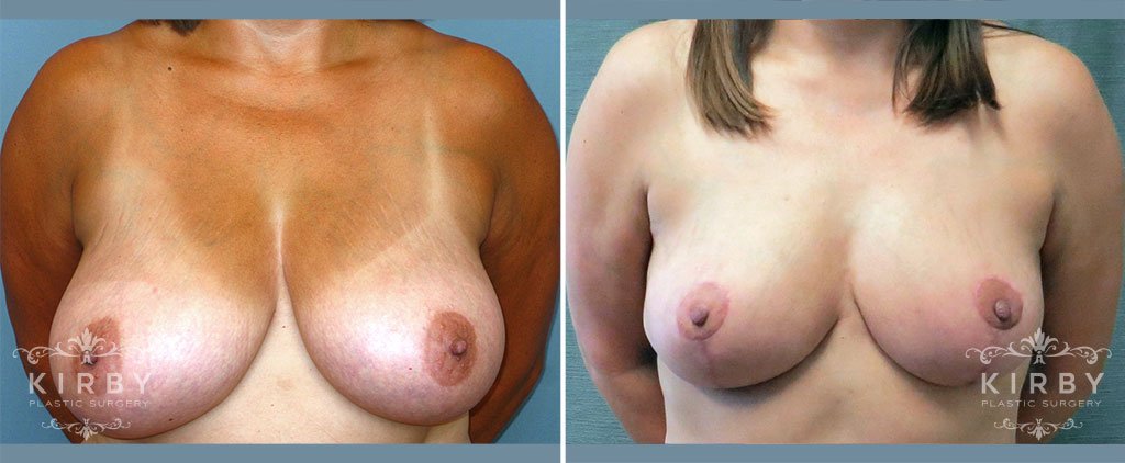 Breast Reduction Patient G12