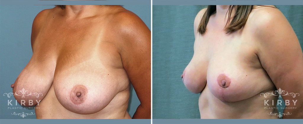 breast-reduction-G102a-left-kirby