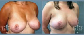 breast-reduction-G102b-kirby