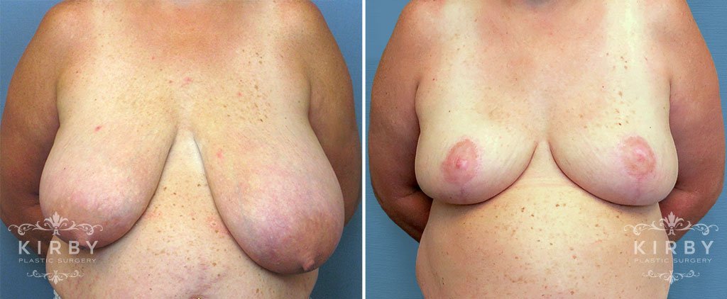 Breast Reduction G123