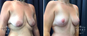mmo-breast-lift-754b-kirby