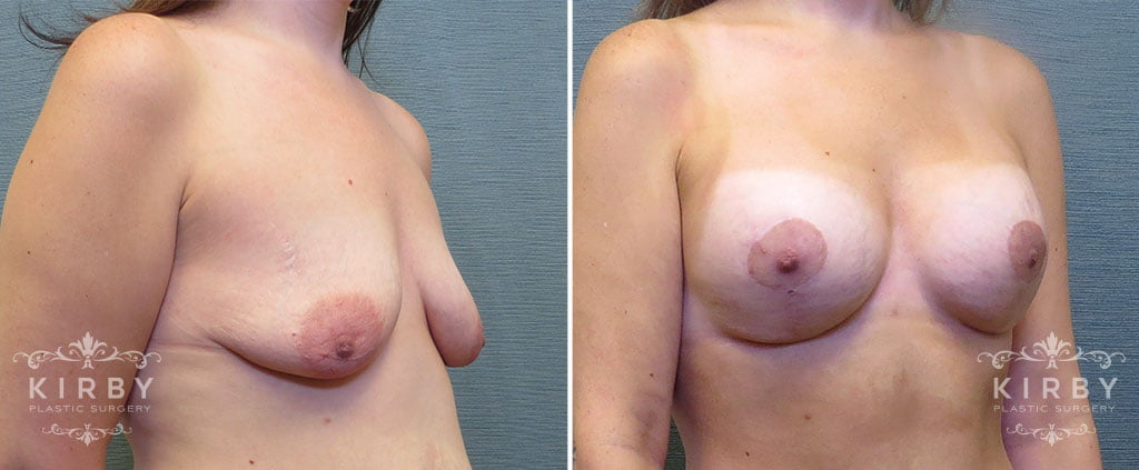 mmo-breast-lift-implants-162b-kirby