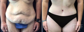 mmo-extended-abdominoplasty-liposuction-754a-kirby