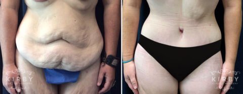Female patient before and after tummy tuck Fort Worth