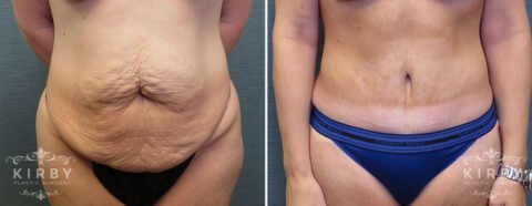 Female patient before and after tummy tuck Fort Worth