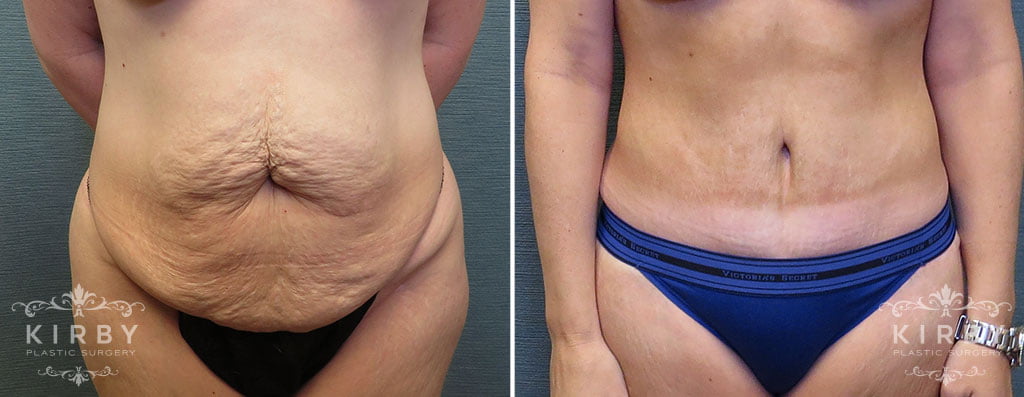 Tummy Tuck with Liposuction G1162