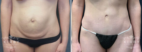 Female patient before and after a mommy makeover with tummy tuck in Fort Worth, TX. Front view.