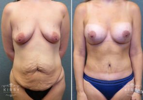 mommy-makeover-tt-breast-lift-implnts-162a-kirby
