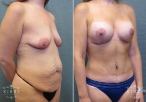 mommy-makeover-tt-breast-lift-implnts-162b-kirby