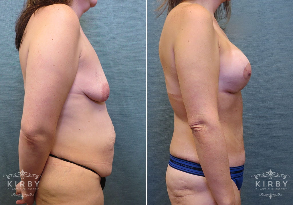 mommy-makeover-tt-breast-lift-implnts-162c-kirby
