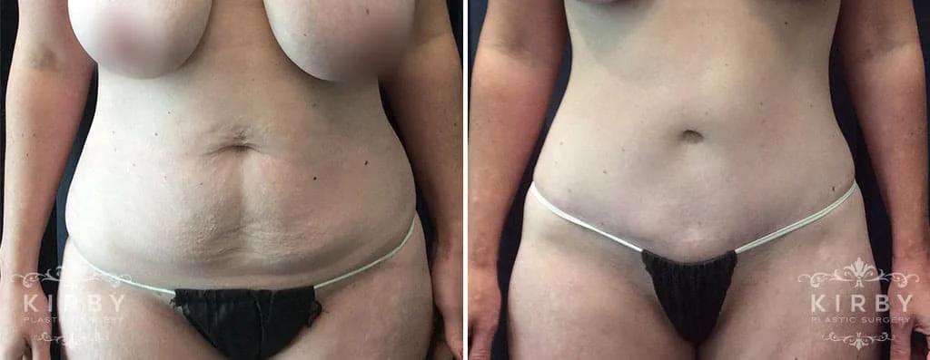 Before and after image of a good tummy tuck result. Notice the slimmer profile, the tighter skin, the reconstructed belly button, and the more toned appearance of the abdomen in this tummy tuck patient 