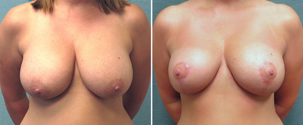 Breast Reduction G121