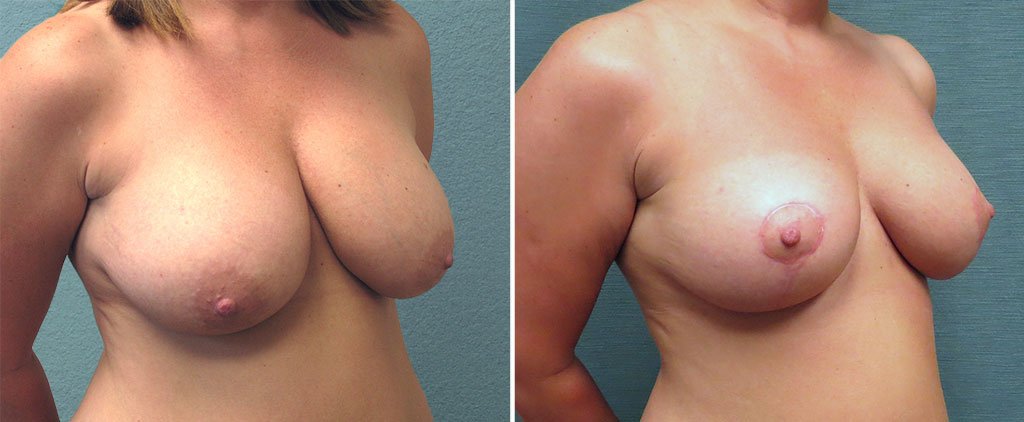 breast-reduction-G121b-kirby