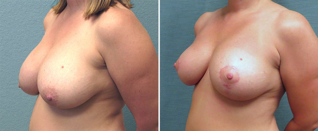 breast-reduction-G121b-left-kirby