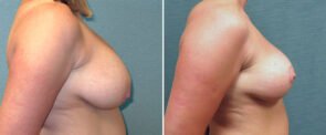 breast-reduction-G121c-kirby