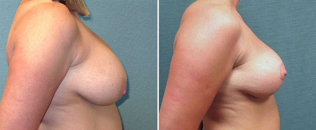 breast-reduction-G121c-kirby