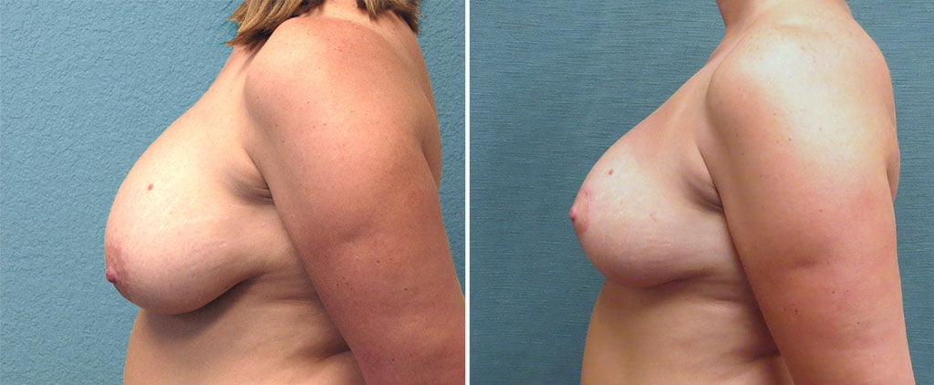 breast-reduction-G121c-left-kirby