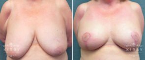 breast-reduction-G122a-kirby