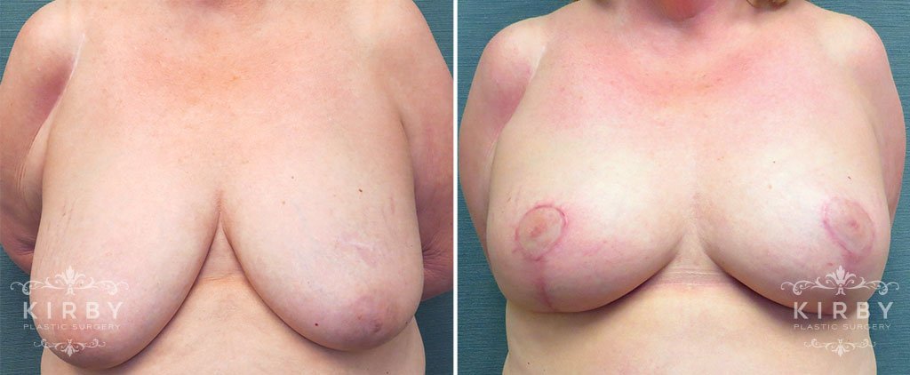 Breast Reduction G122