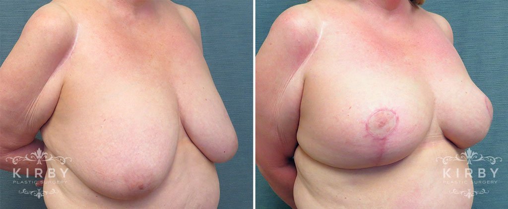 breast-reduction-G122b-kirby