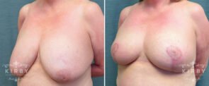 breast-reduction-G122b-left-kirby