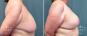breast-reduction-G122c-kirby