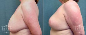 breast-reduction-G122c-left-kirby