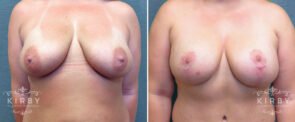 mmo-breast-lift-implants-157a-kirby