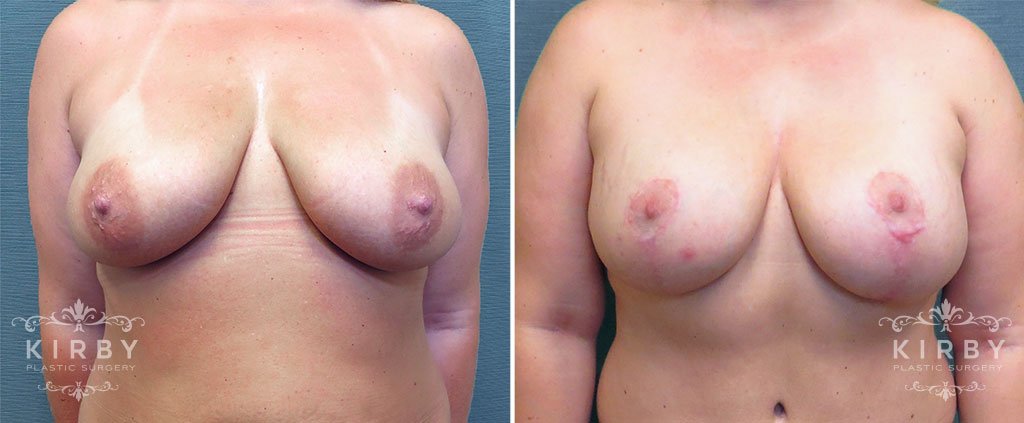 Breast Lift with Implants G1157