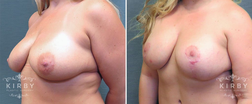 mmo-breast-lift-implants-157b-left-kirby