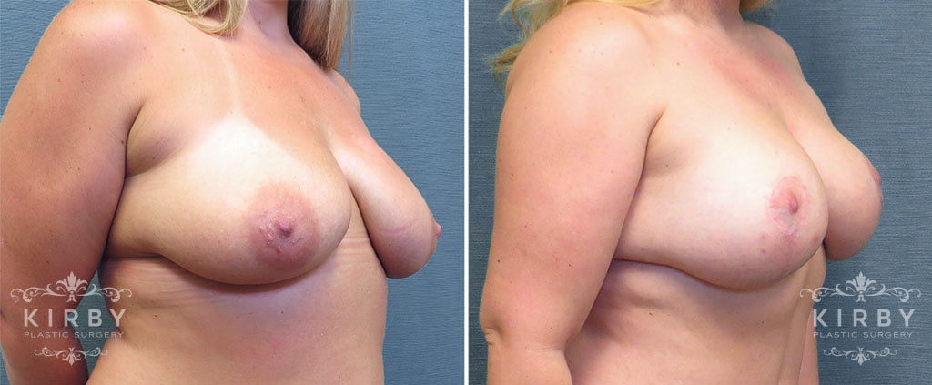 mmo-breast-lift-implants-157b-right-kirby