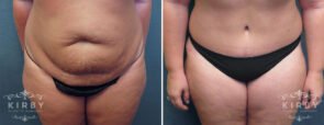 Tummy Tuck with Liposuction G1157