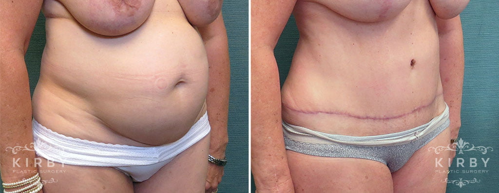 Tummy Tuck G1166