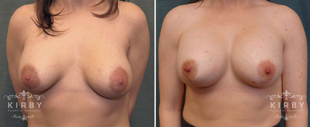 Breast Lift with Implants G1104