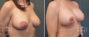 breast-lift-implants-G1104b-kirby