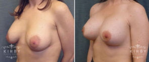 breast-lift-implants-G1104b-left-kirby