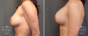 breast-lift-implants-G1104c-left-kirby