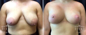 Breast Lift with Implants G1672