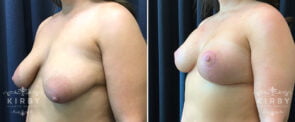 breast-lift-implants-G1672b-kirby
