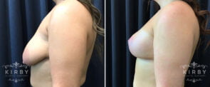 breast-lift-implants-G1672c-kirby
