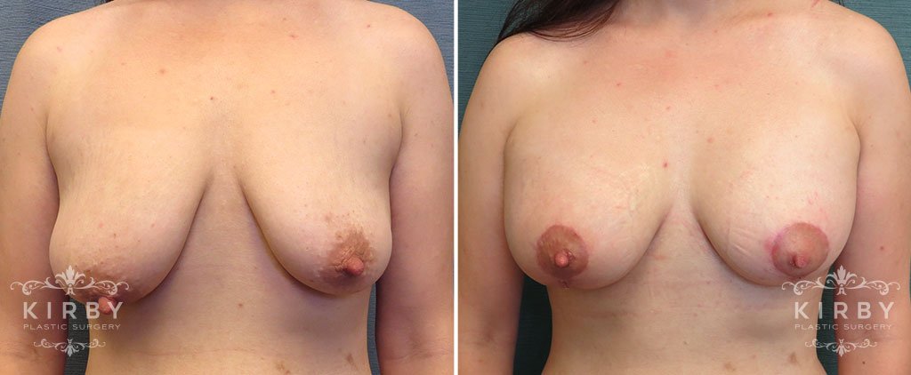 Breast Lift with Implants G175
