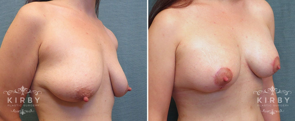 breast-lift-implants-G175b-kirby