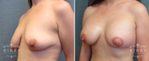 breast-lift-implants-G175b-left-kirby