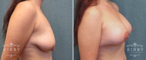 breast-lift-implants-G175c-kirby