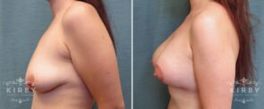 breast-lift-implants-G175c-left-kirby