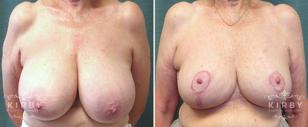 Breast Reduction G138