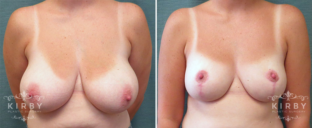 Breast Reduction G153
