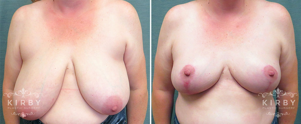 Breast Reduction G185
