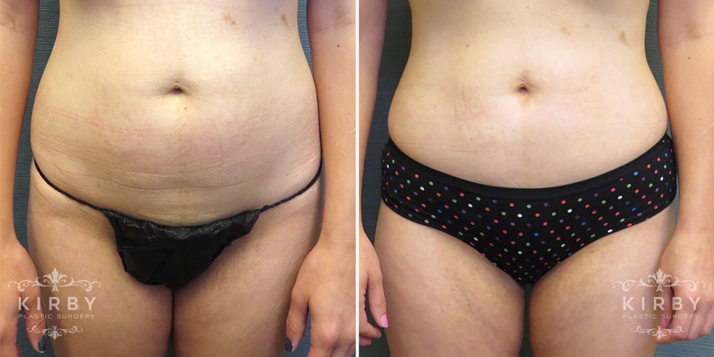 Liposuction G175